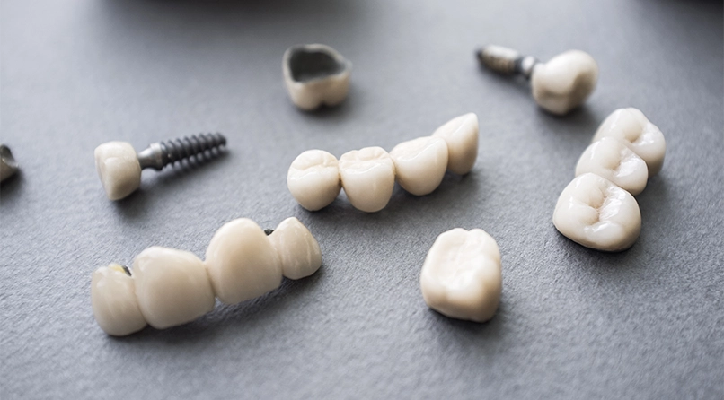 Dental Crowns and Bridges Closeup