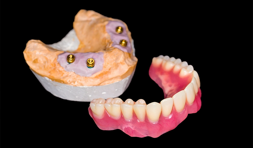 Dental Implant All on Four