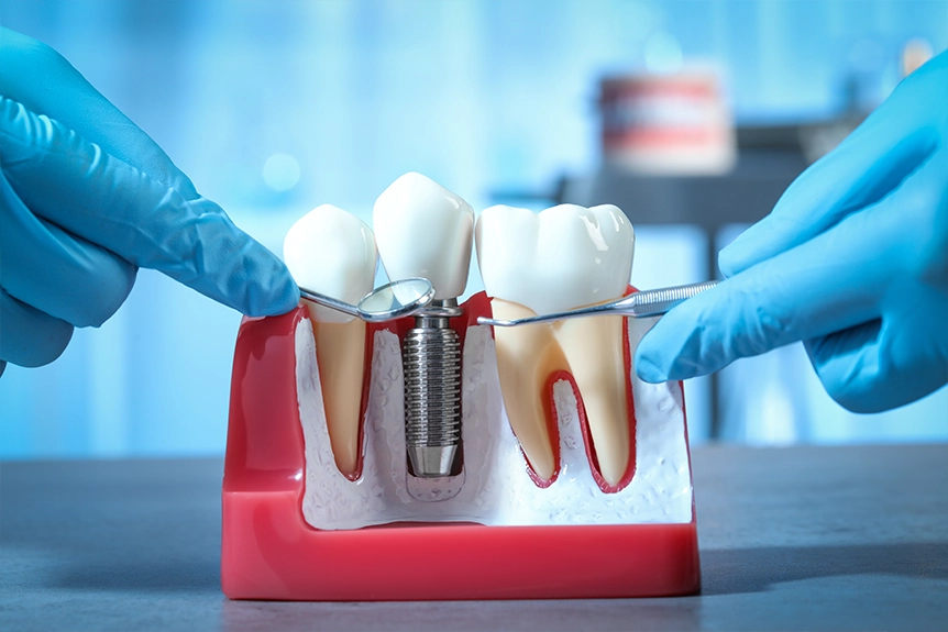 Dental Implant Closeup
